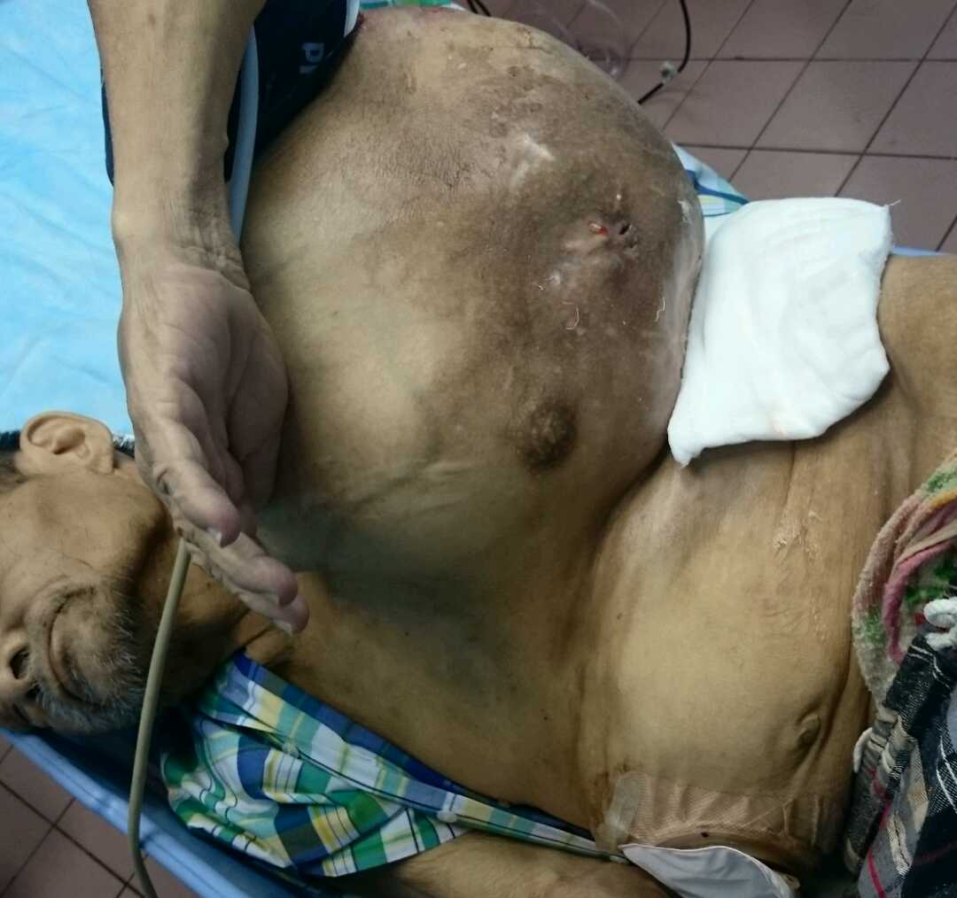 tumor